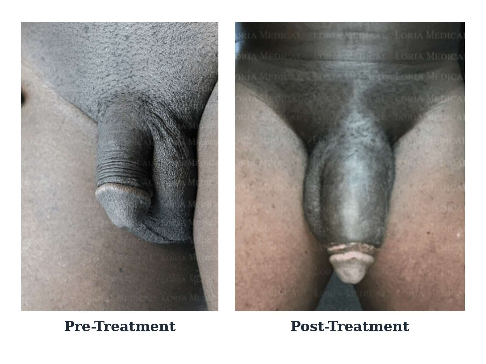 Before and after — case 17