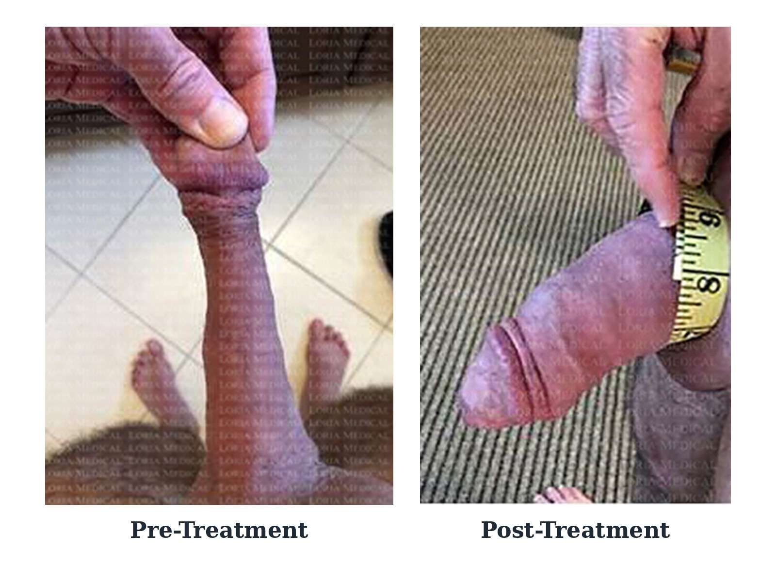 Before and after — case 14