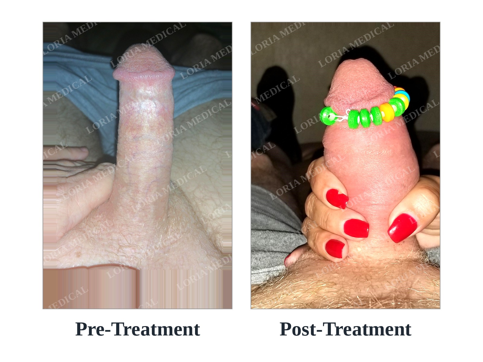 Before and after — case 44